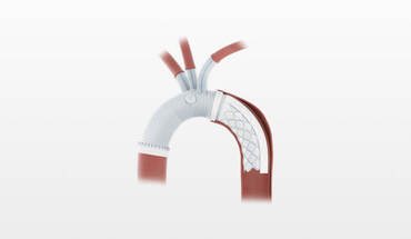 Endografting
